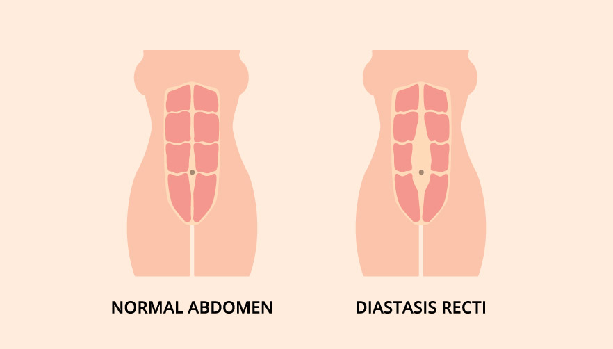 split abs after birth