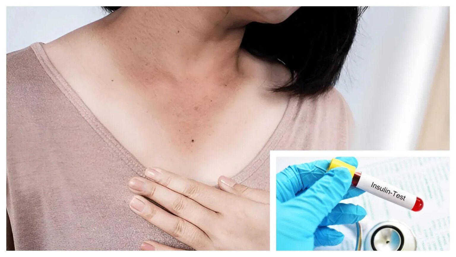 Dark patches on your child’s neck? Doctor says it may be a sign of insulin resistance