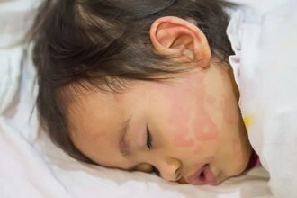 How to Manage Hives in Kids