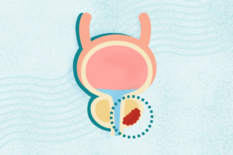What Is Prostate Cancer? Symptoms, Stages, Diagnosis, Treatment, and More