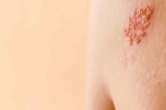 Shingles Action Week 2026: Why seniors with chronic illnesses are at greater risk