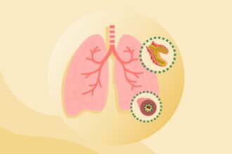 What Is Bronchiectasis?