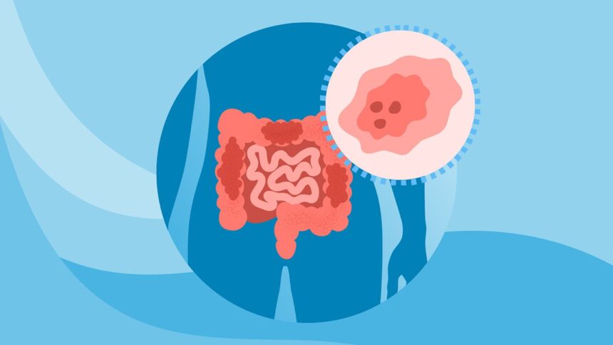 What Is Early-Onset Colorectal Cancer?