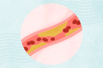 What Is High Cholesterol?