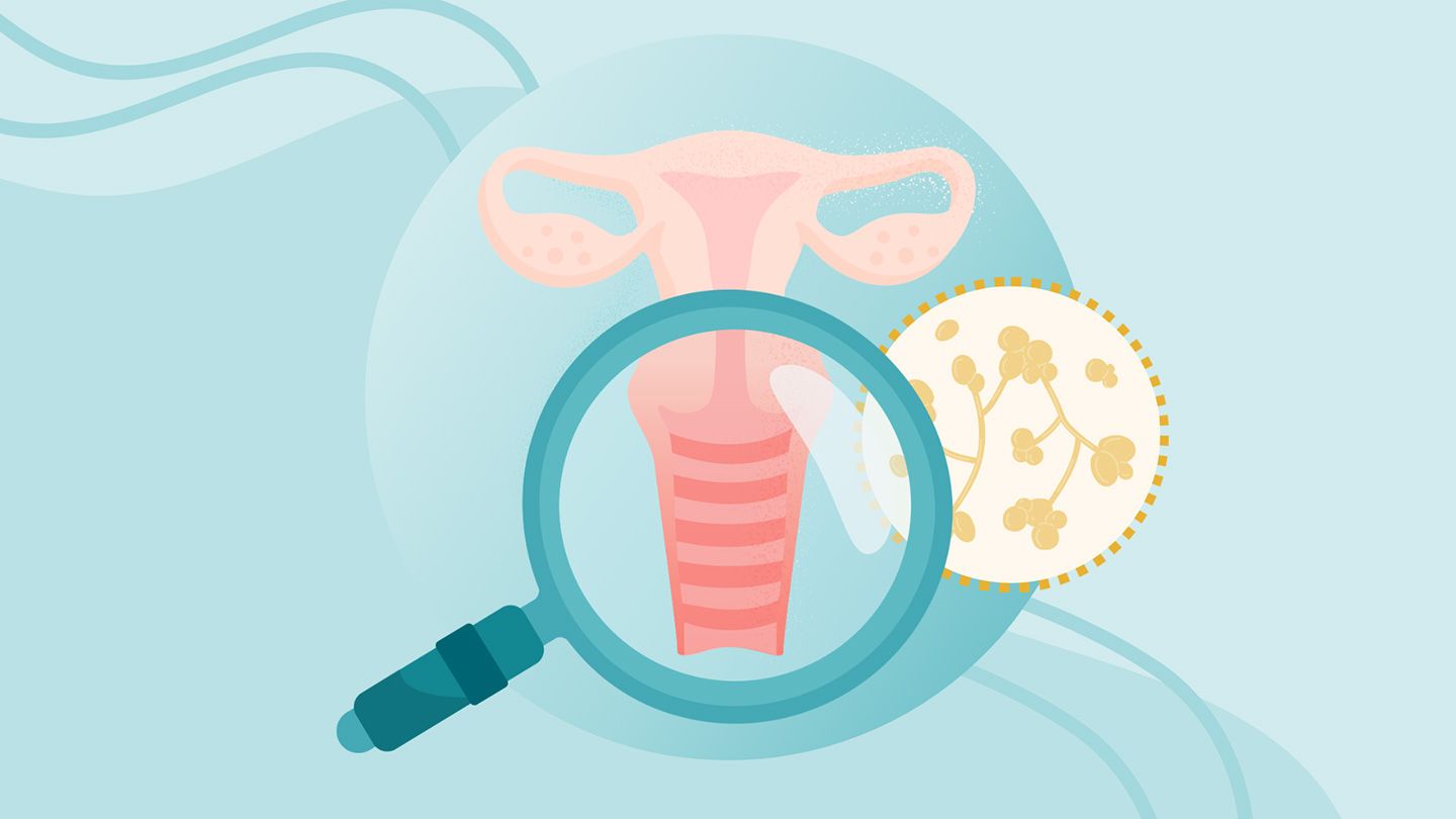 What Is a Yeast Infection? Symptoms, Causes, Diagnosis, Treatment, and Prevention